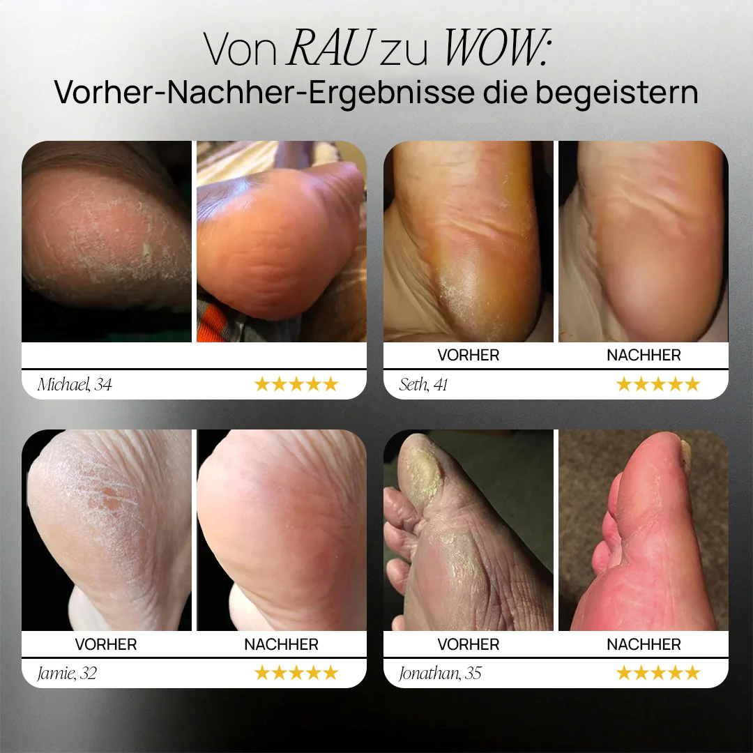Velderma™ Elektrischer Hornhaut Entferner